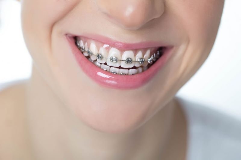 Niềng răng mắc cài tự động