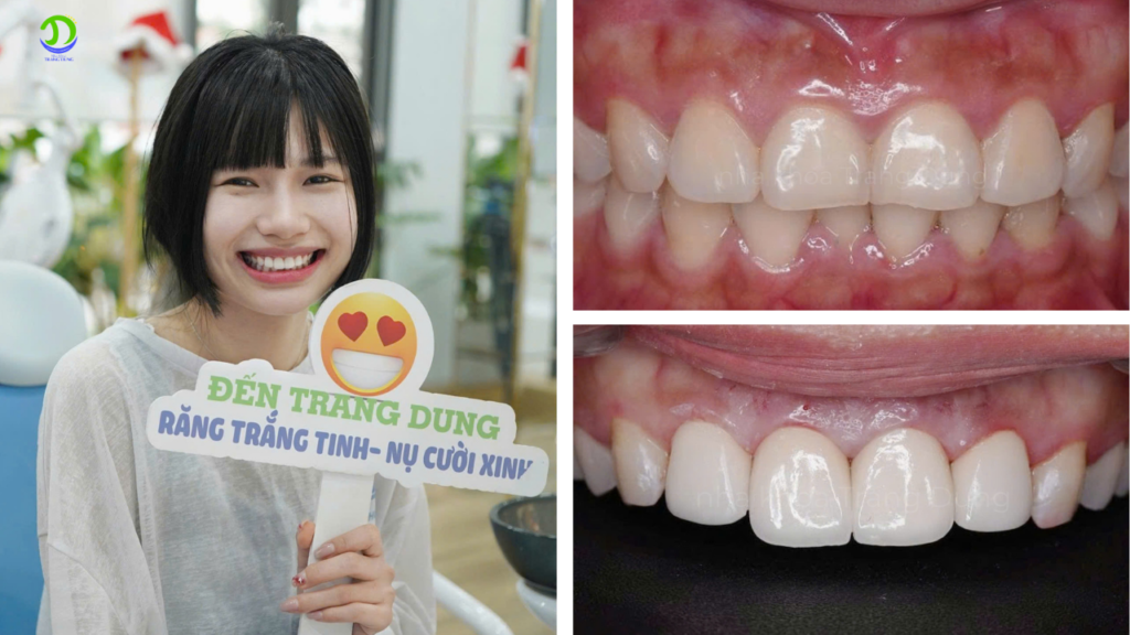 Bọc răng sứ tại Hà Nội