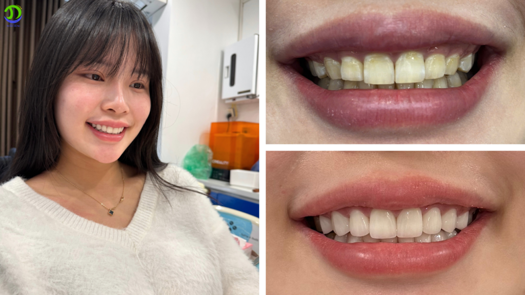 răng sứ trước sau