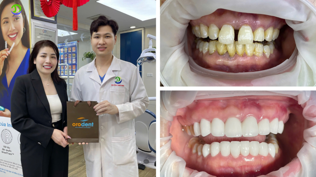 Giá dán răng sứ thẩm mỹ​