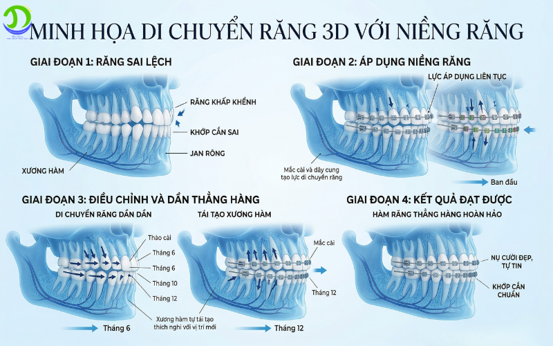 Niềng răng cho người lớn 30–40 tuổi có hiệu quả không? minh họa 3d niềng răng di chuyển răng