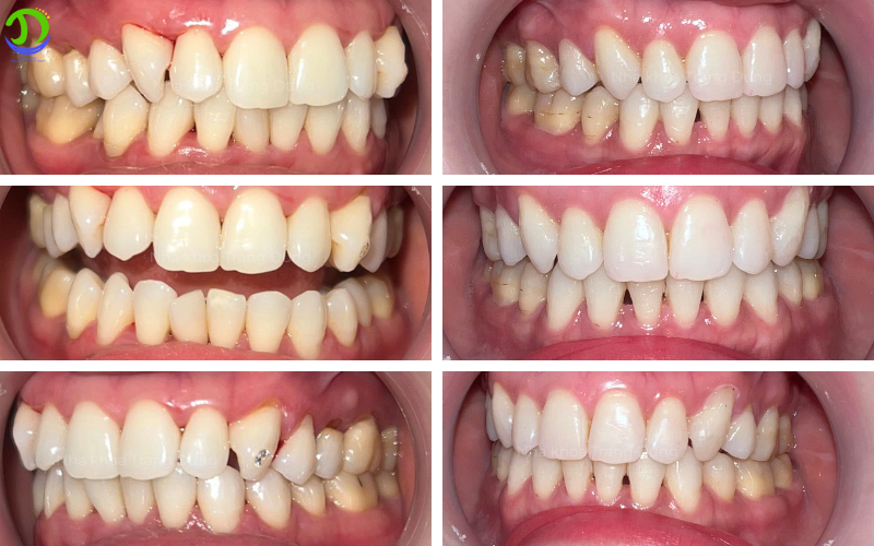 Niềng răng cho người lớn 30–40 tuổi có hiệu quả không? niềng răng cho khách hàng sinh năm 1990