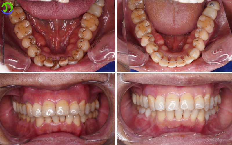 Niềng răng cho người lớn 30–40 tuổi có hiệu quả không? khách hàng 58 tuổi niềng răng trong suốt hàm dưới tại nha khoa trang dung