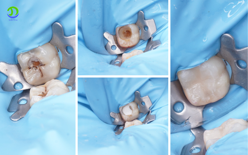 Điều trị tủy xong có cần bọc sứ không? ca điều trị tủy tại nha khoa Trang Dung