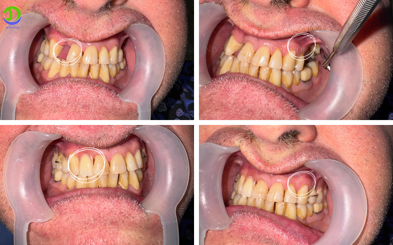 Hàm giả tại Nha khoa Trang DUng