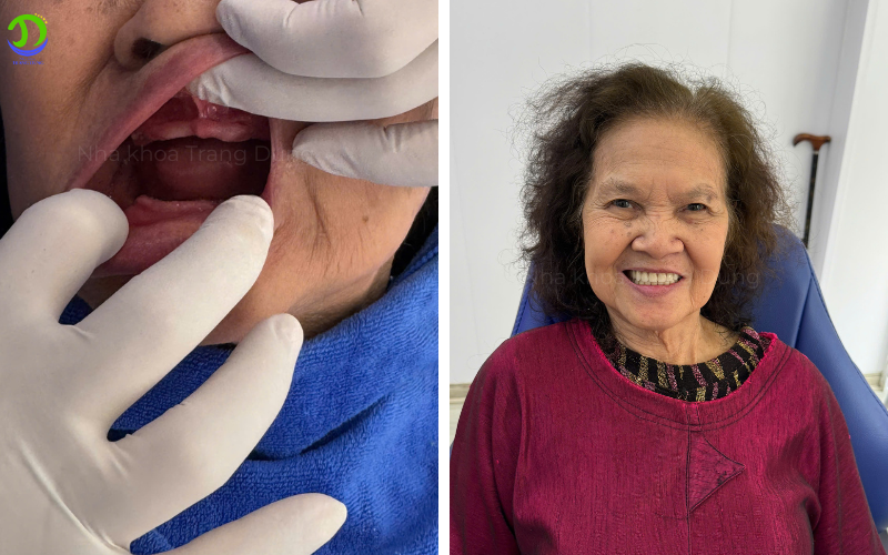 hàm giả được làm tại nha khoa trang dung