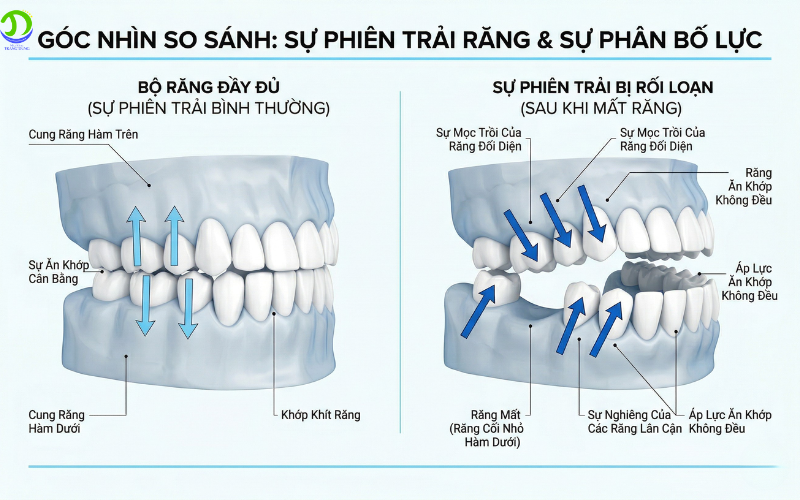 Vì sao mất răng làm răng còn lại lệch dần dù chỉ mất 1 răng Mất răng gây xô lệch toàn hàm
