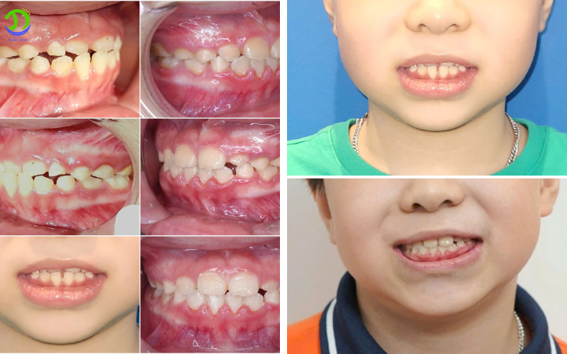 niềng răng cho trẻ