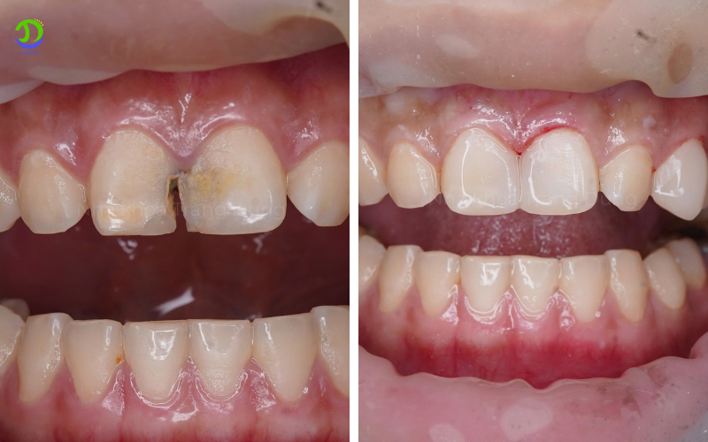 Răng sâu trước và sau khi điều trị Tại Nha khoa Trang DUng