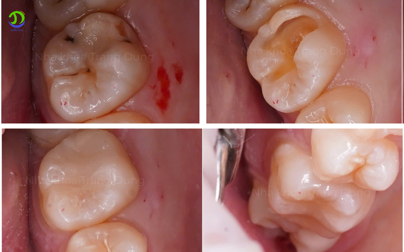 Răng sâu trước sau điều trị tại Nha khoa Trang DUng