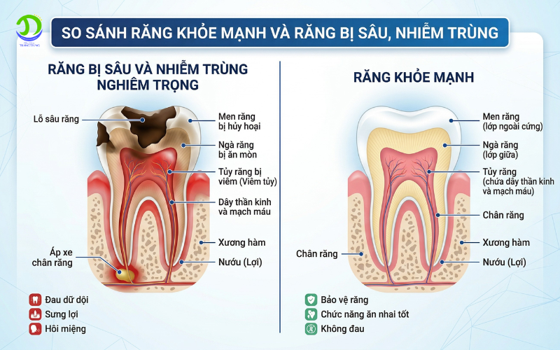 Điều trị tủy xong có cần bọc sứ không? điều trị tủy