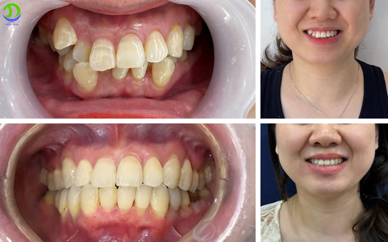 niềng răng trước và sau tại Nha khoa Trang Dung