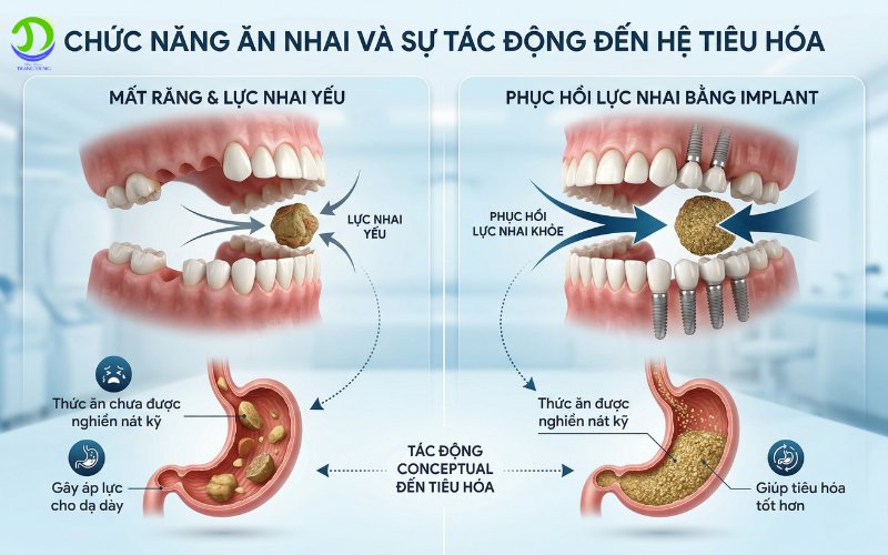 dấu hiệu cần trồng răng implant - ảnh hưởng tiêu hóa