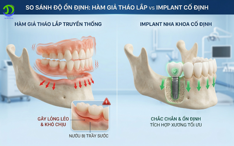 dấu hiệu cần trồng răng implant - hàm giả