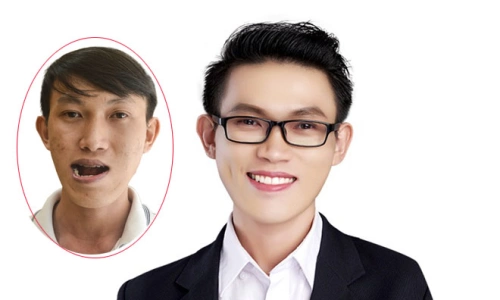 Mặt lưỡi cày là gì