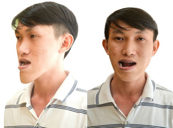 Mặt lưỡi cày là gì