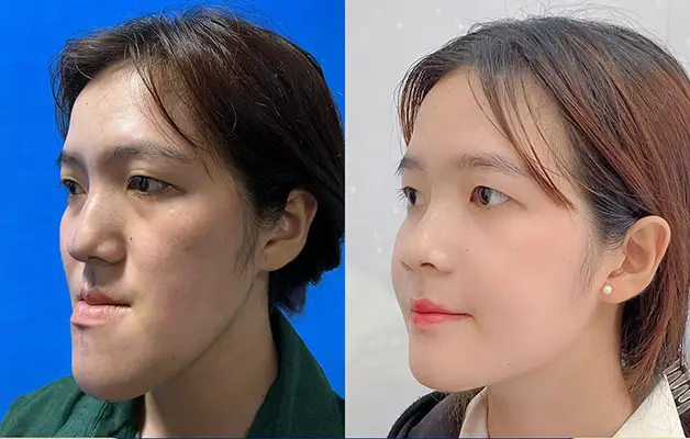 Mặt lưỡi cày là gì