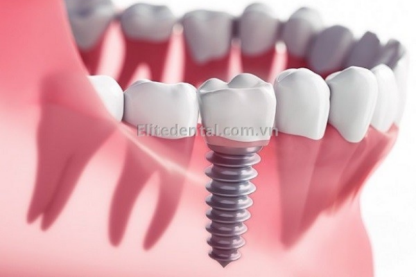 cấy ghép implant mất bao lâu