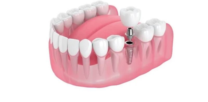 cấy ghép implant mất bao lâu