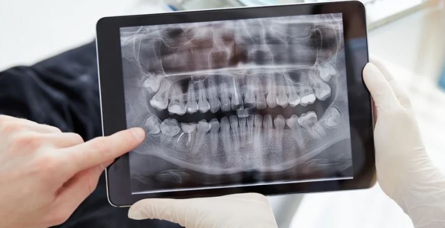 Cùng Tìm Hiểu Làm Răng Implant Giá Bao Nhiêu 2026? làm răng implant giá bao nhiêu