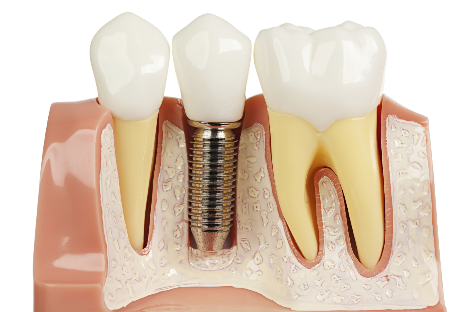 Cùng Tìm Hiểu Làm Răng Implant Giá Bao Nhiêu 2026? làm răng implant giá bao nhiêu