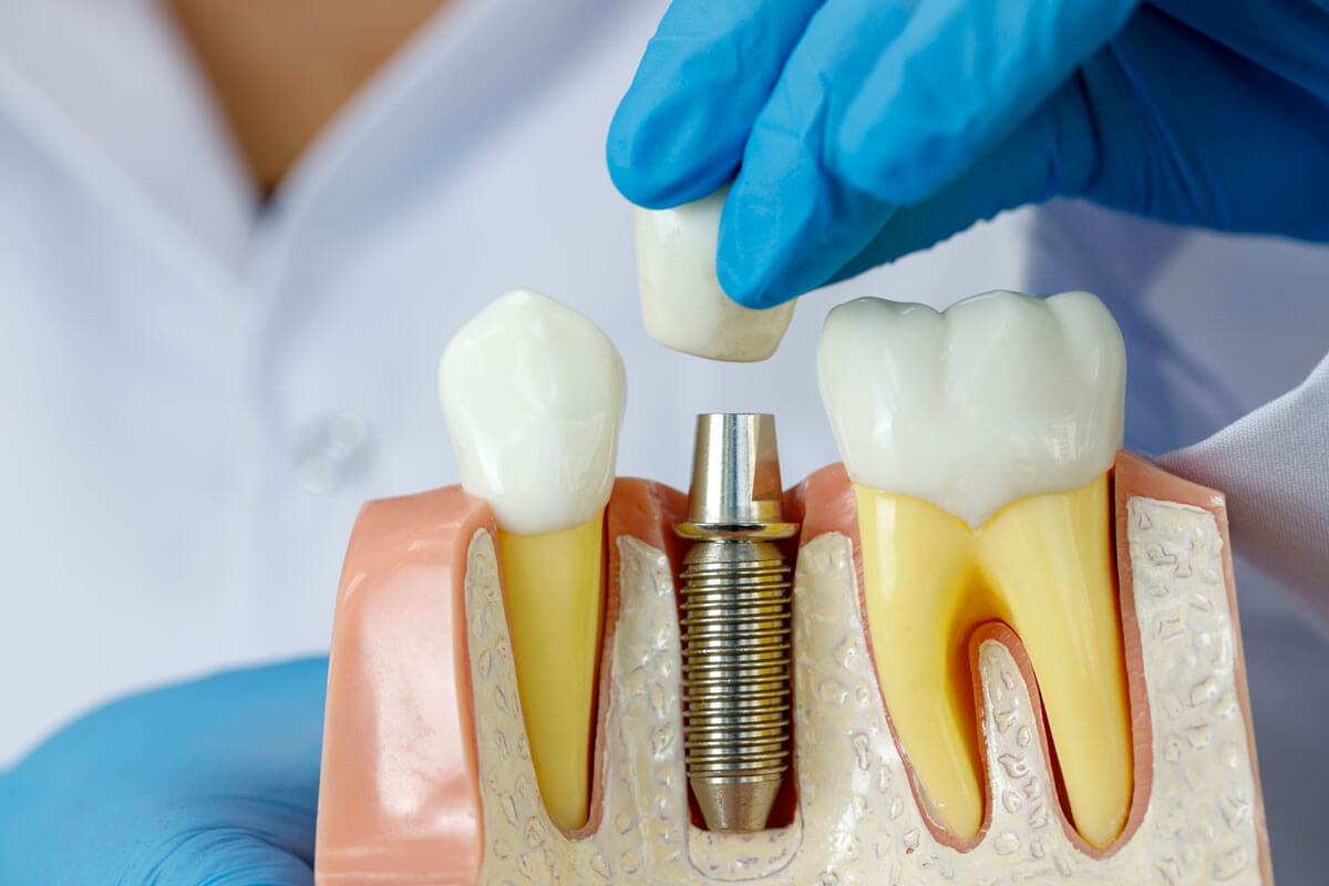 Cùng Tìm Hiểu Làm Răng Implant Giá Bao Nhiêu 2026? làm răng implant giá bao nhiêu