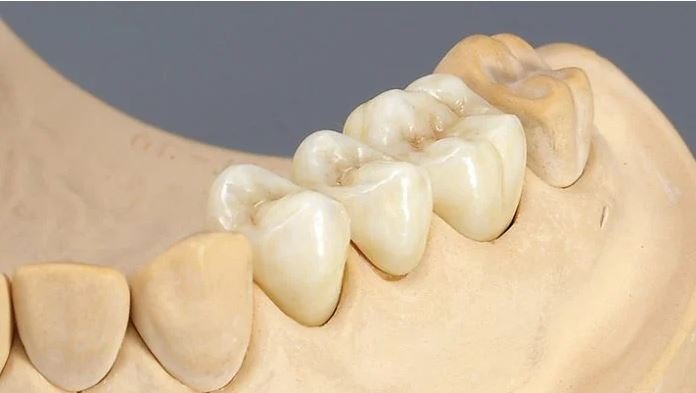 giá làm răng implant​