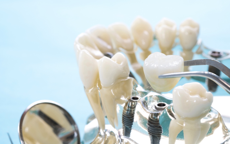 giá trồng răng implant ở hà nội​