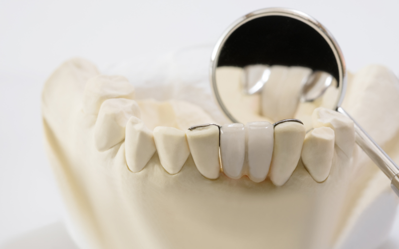 giá trồng răng implant ở hà nội​