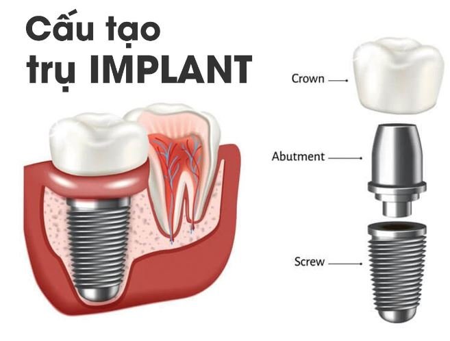 giá trồng răng implant ở hà nội​