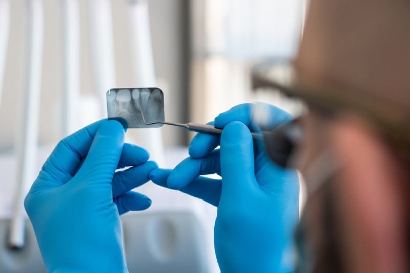cấy ghép implant mất bao lâu