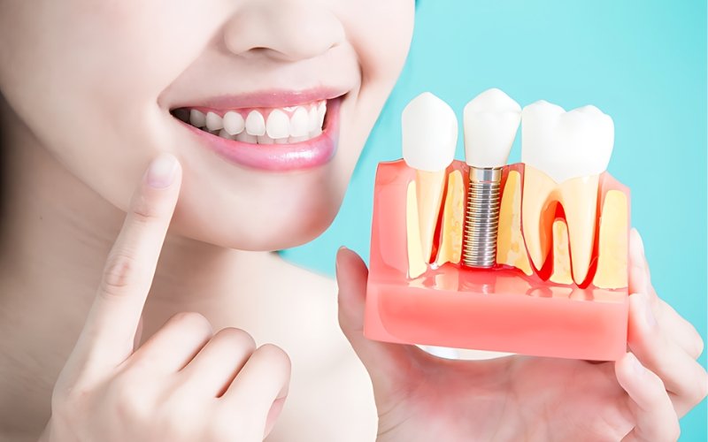 cấy ghép implant mất bao lâu