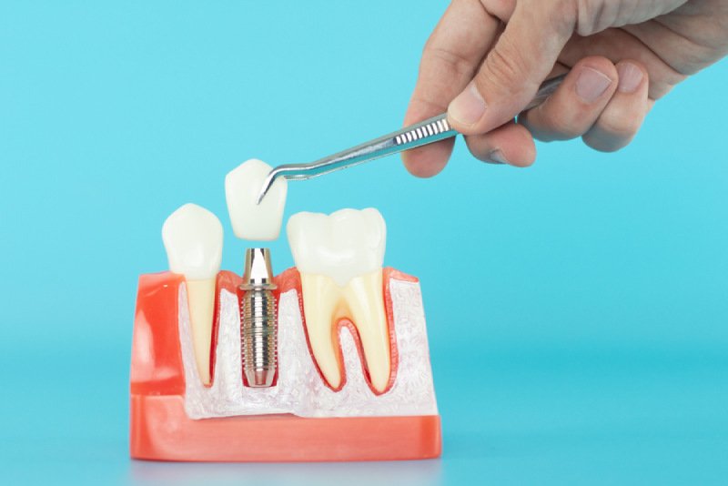 cấy ghép implant mất bao lâu