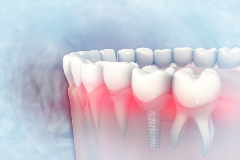 cấy ghép implant mất bao lâu