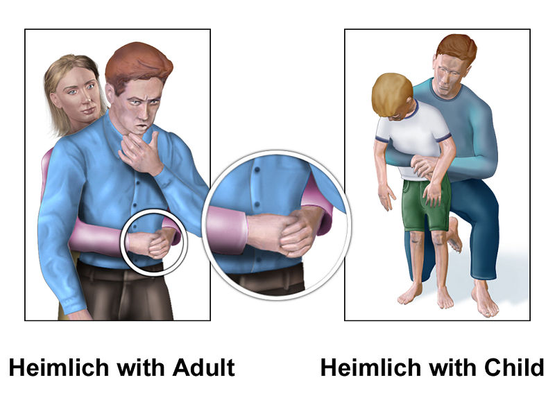 Cách trị hóc xương cá ở cổ họng tại nhà