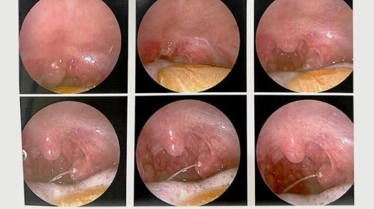 Cách trị hóc xương cá ở cổ họng tại nhà