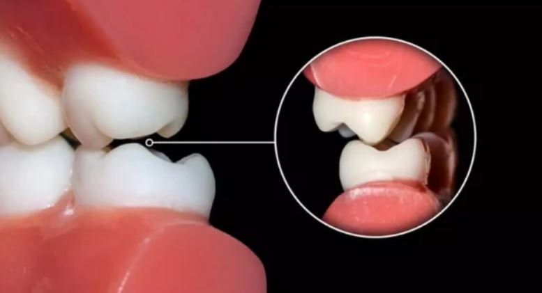 Gợi ý cách chữa nghiến răng khi ngủ dân gian đơn giản mà hiệu quả cách chữa nghiến răng khi ngủ dân gian