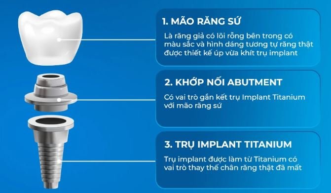 Cấy Ghép Implant Giá Bao Nhiêu