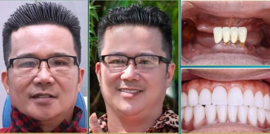 Cấy Ghép Implant Giá Bao Nhiêu
