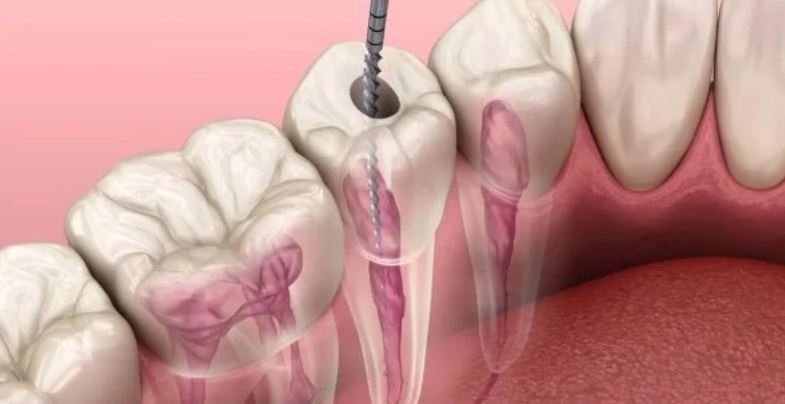 Điều trị tủy răng Hà Nội: Giải pháp bảo tồn răng an toàn, hiệu quả Điều trị tủy răng Hà Nội