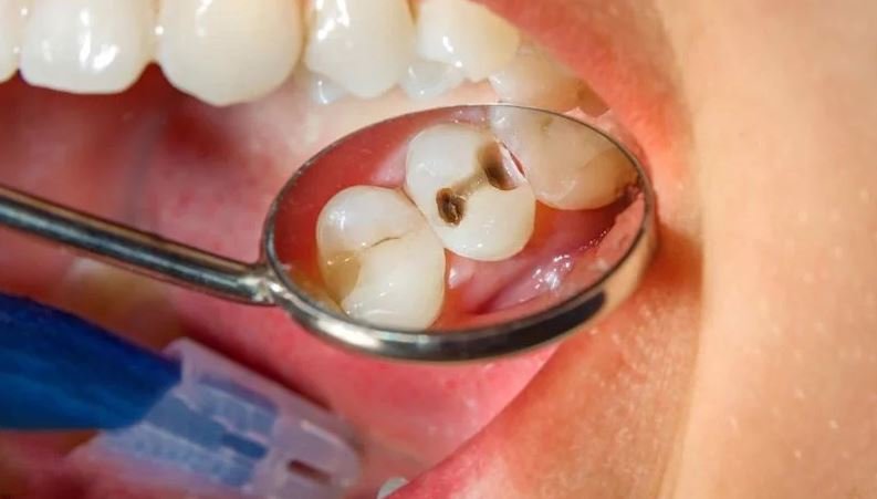 Điều trị tủy răng Hà Nội