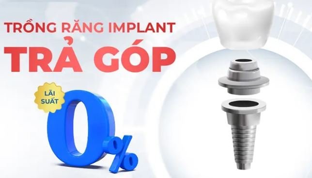 làm răng trả góp