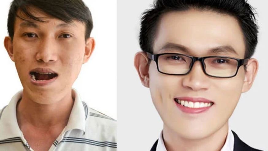 Khuôn mặt bị lệch khi chụp ảnh