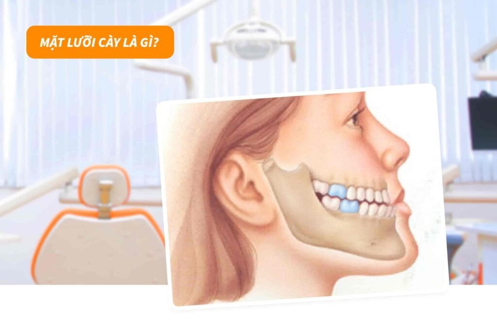 Mặt lưỡi cày là gì