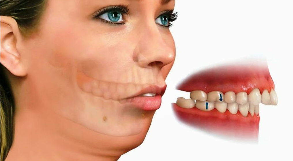 Mặt lưỡi cày là gì