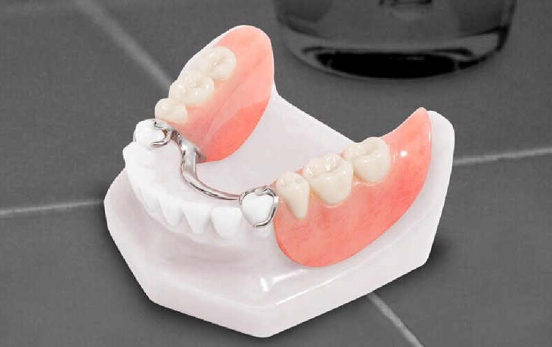 trồng răng giả tháo lắp​
