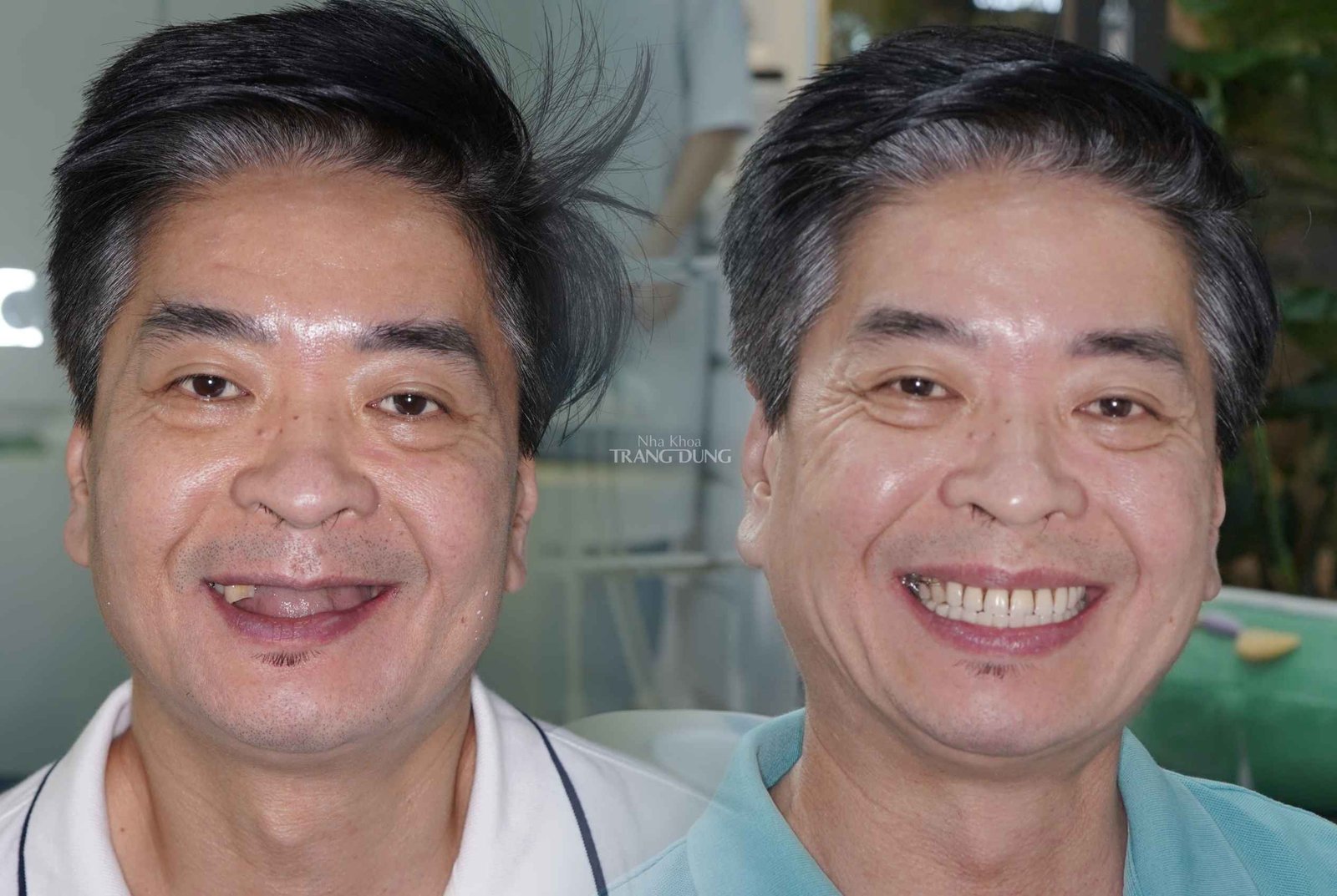 Trồng răng Implant tại Nha khoa Trang Dung