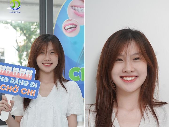 Niềng răng sinh viên tại Nha khoa Trang Dung
