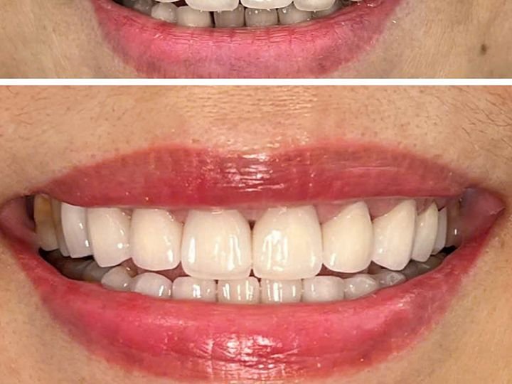 Thẩm mỹ răng sứ toàn hàm tại Nha khoa Trang Dung