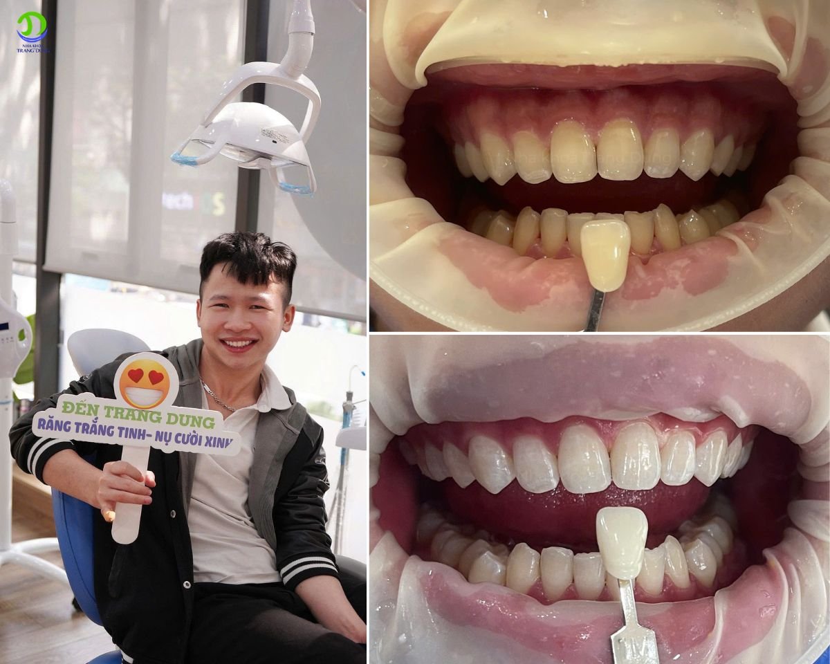 Tẩy trắng răng tại Nha khoa Trang Dung